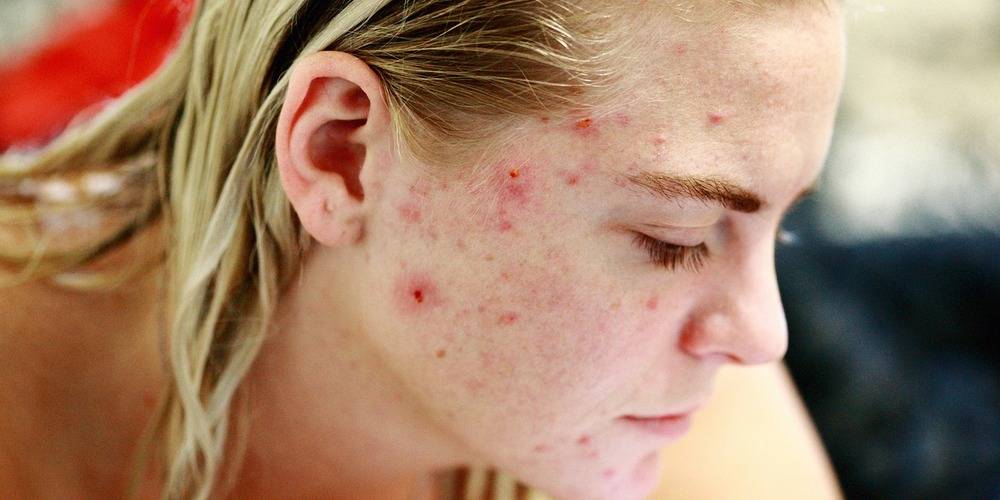 Adult Acne and Teen Acne